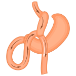 mini_bypass_gastric